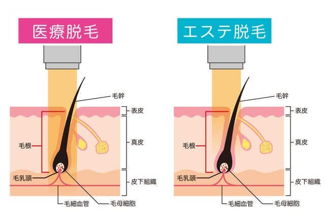 医療脱毛とエステ脱毛の違い